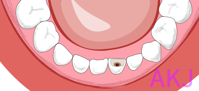 如果牙齿有蛀牙不治疗会怎样？ 