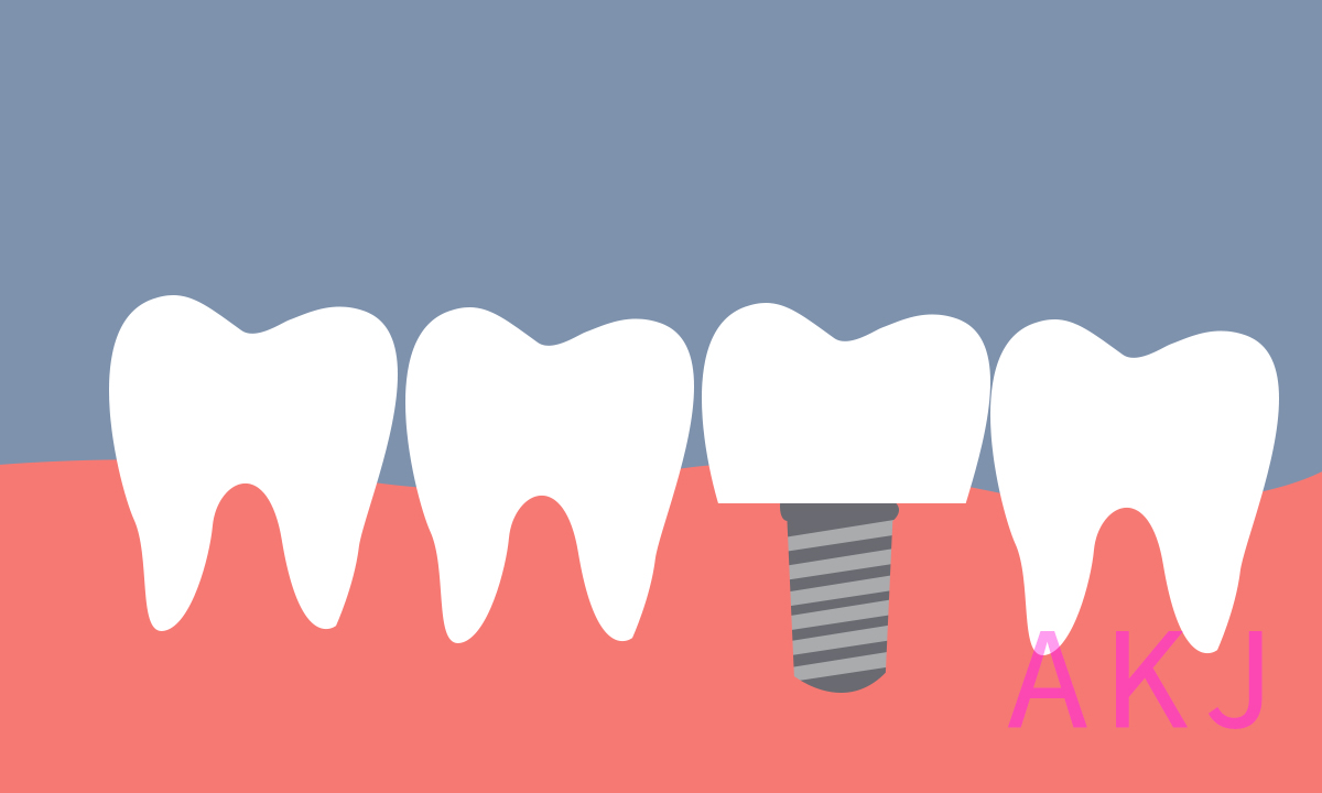 种植牙的使用寿命是多久？要怎么维护保养