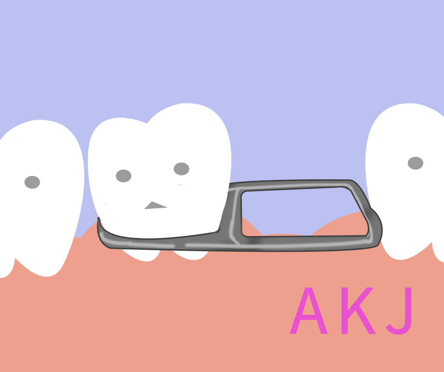 缺牙该怎么办？一文比较种植牙、固定式牙桥及活动假牙3大缺牙治疗方案！