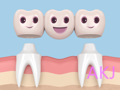 怎么选择牙冠?牙冠有哪些类型,不同牙冠的优缺点