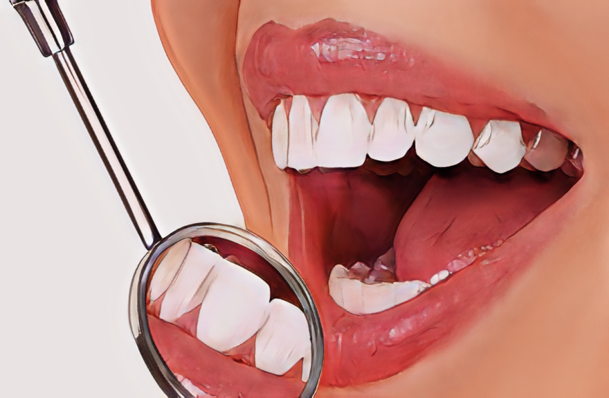 揭秘蛀牙背后的真相：龋齿是如何悄悄侵袭您的牙齿？
