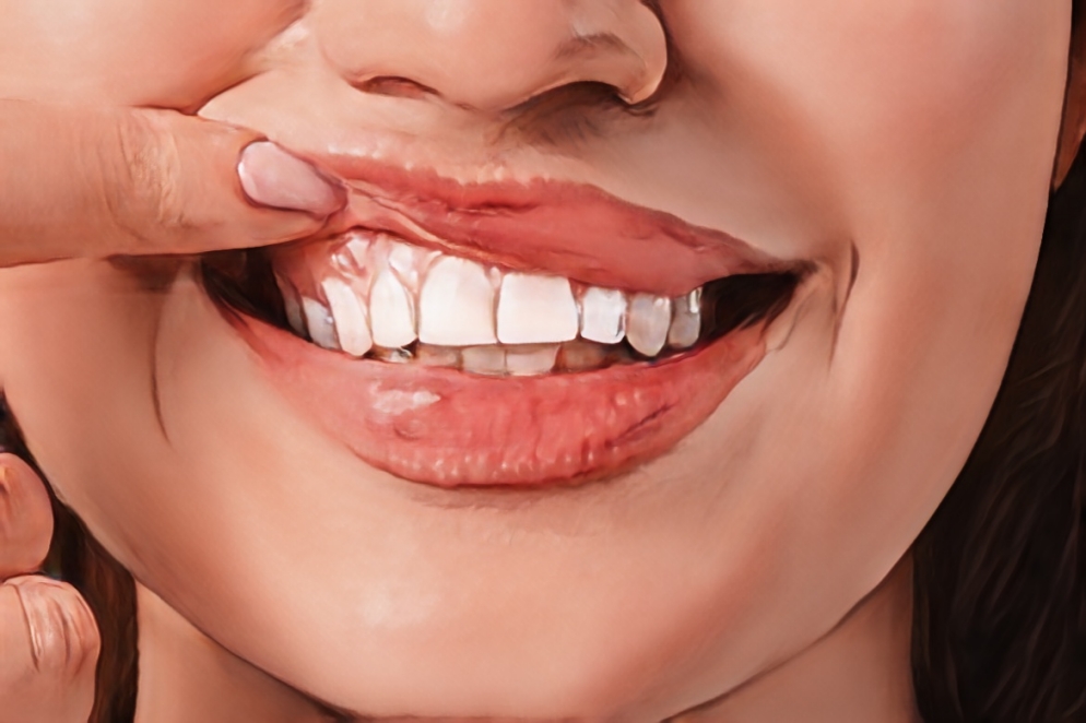 牙齿变长？牙龈退缩的预警信号及其治疗方案