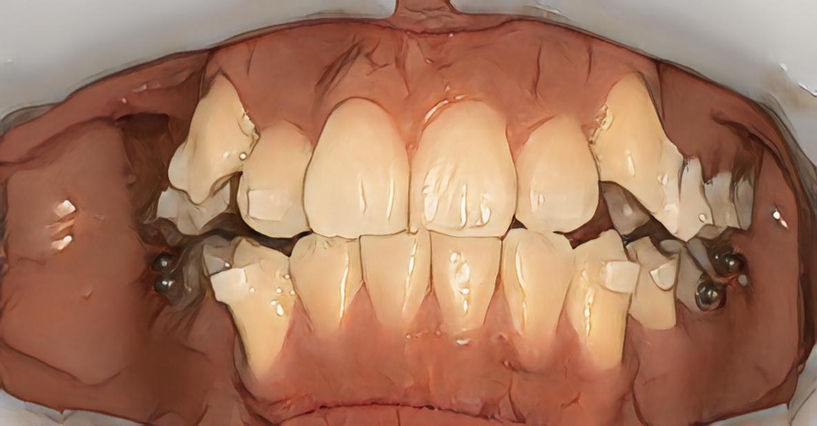 尖牙和虎牙的区别及矫正图片